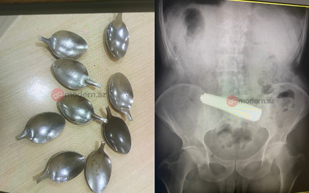 Bakı sakini 9 ədəd qaşıq uddu - FOTOLAR